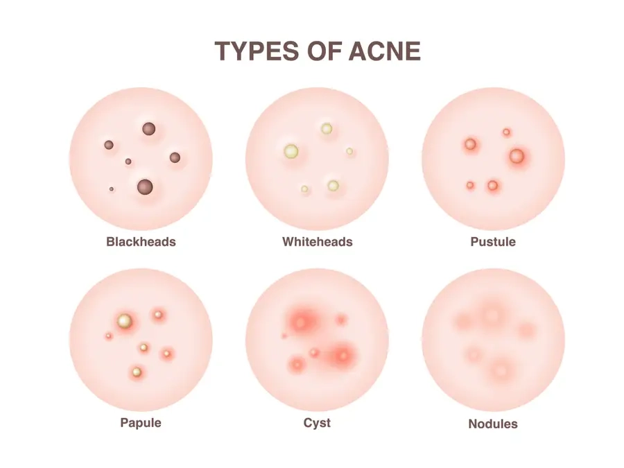 Different Types of Acne skin care doctors near me Dr Vedant Ghuse