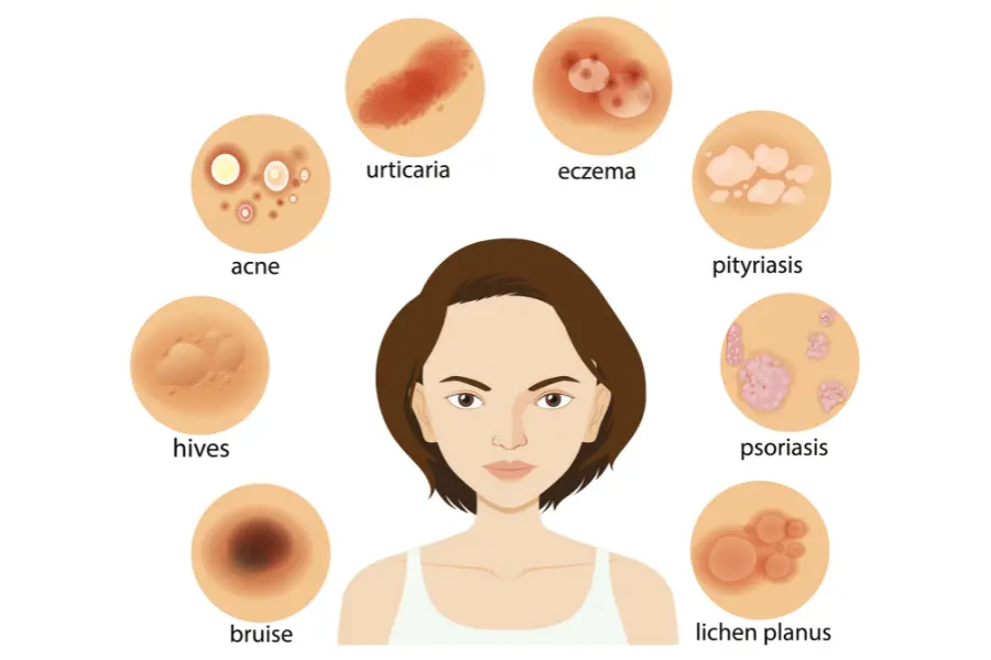 Different Types of Skin Tags Explained