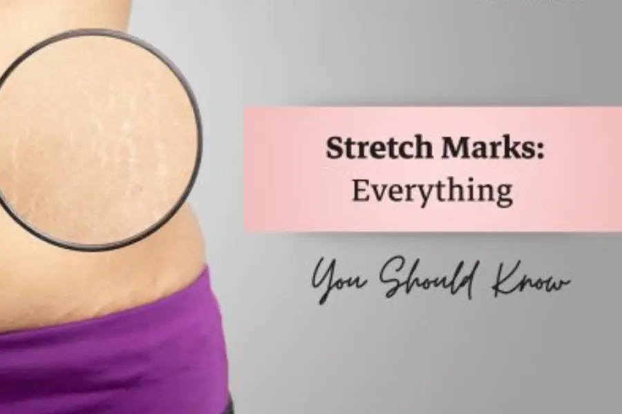Details About Stretch Marks | Skin Doctor in Chembur