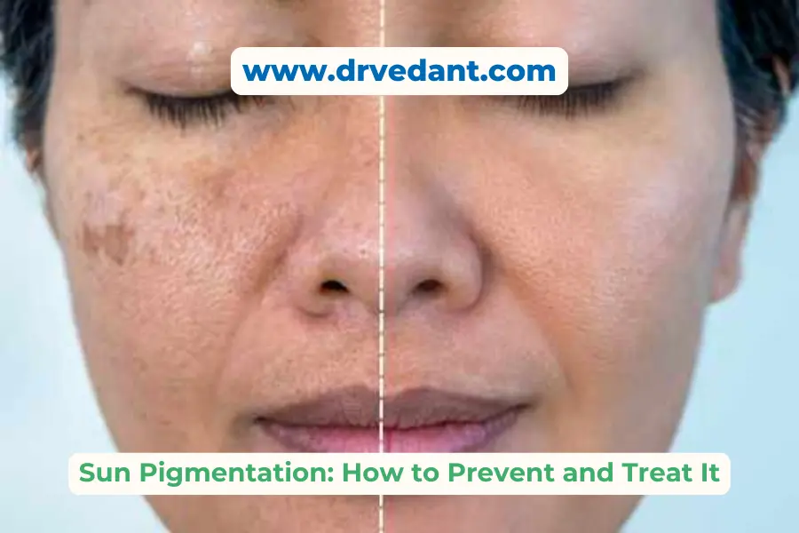Sun Pigmentation:Prevent and Treat | Dermatologist Near Me