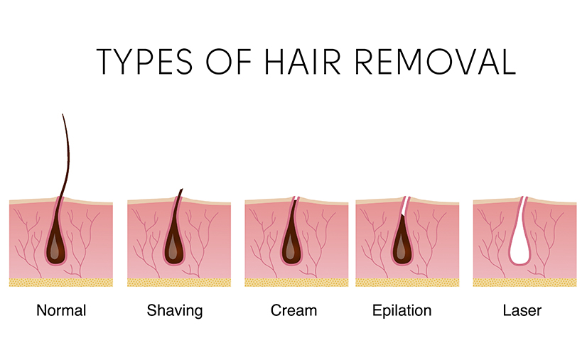 Understanding Different Types of Hair Removal