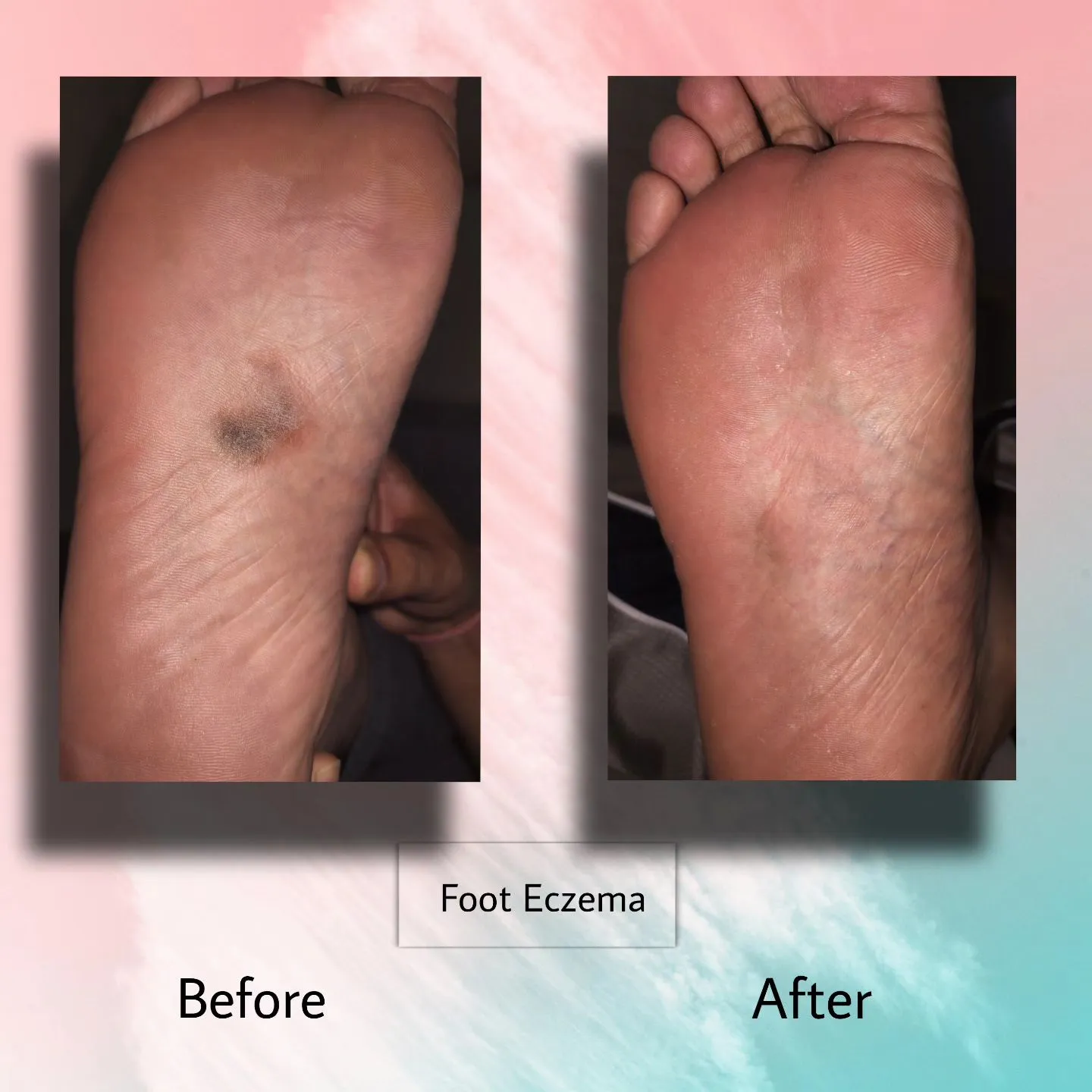 Before & After of Foot Eczema