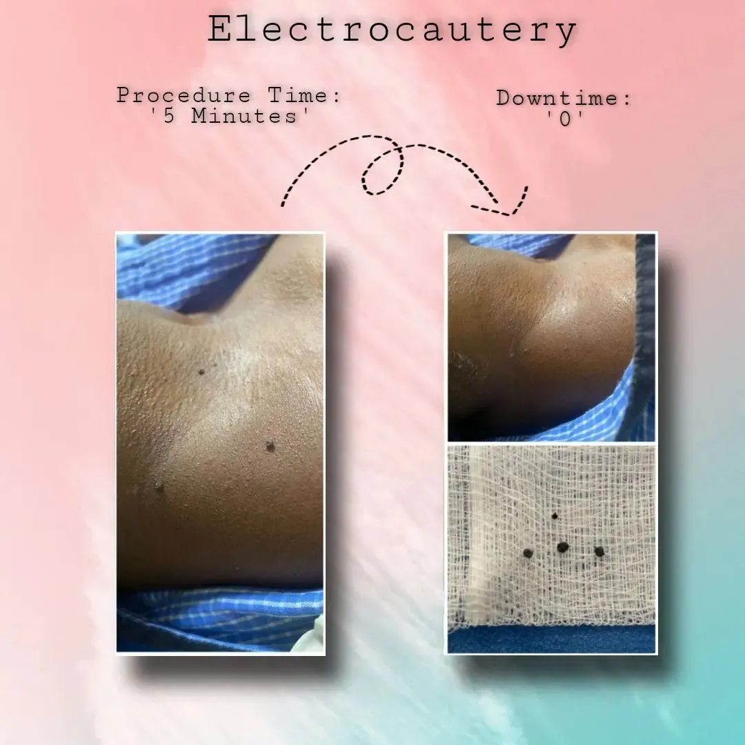 Electrocautery of Acrochordons or Skin Tags on the neck