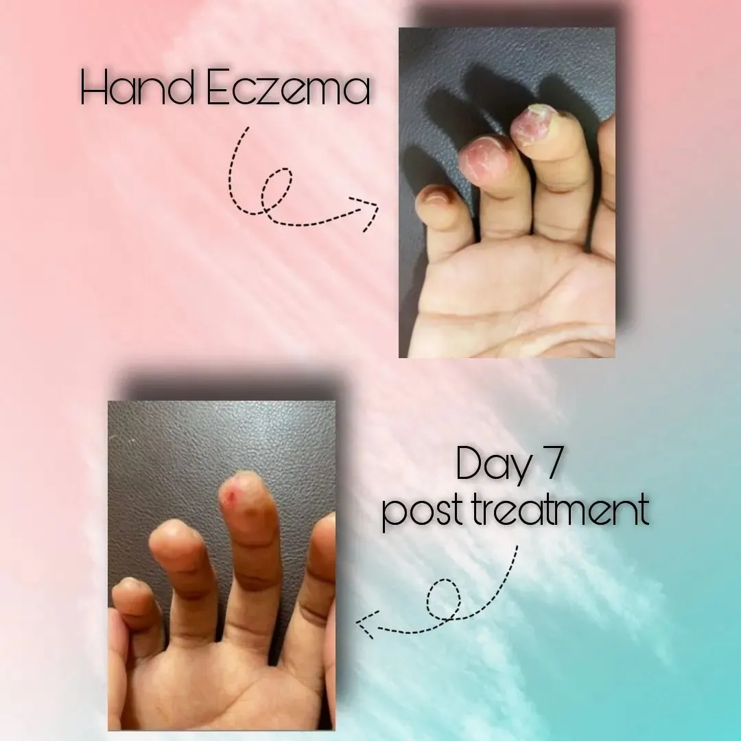 Hand Eczema Pre & post treatment- Dermatologist in Chembur