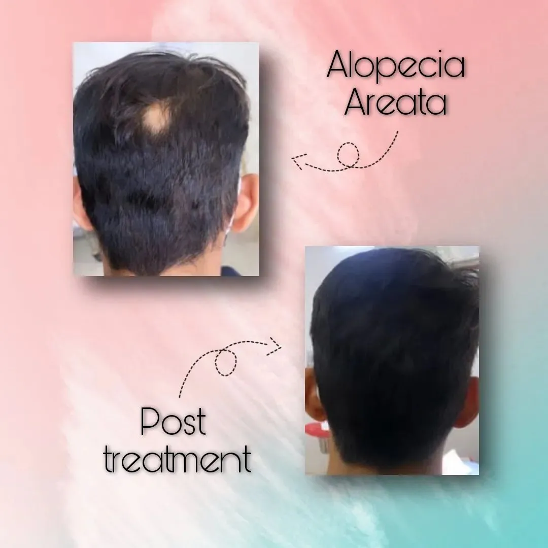 Alopecia Areata Pre & Post Treatment-Dermatologist in Chembur