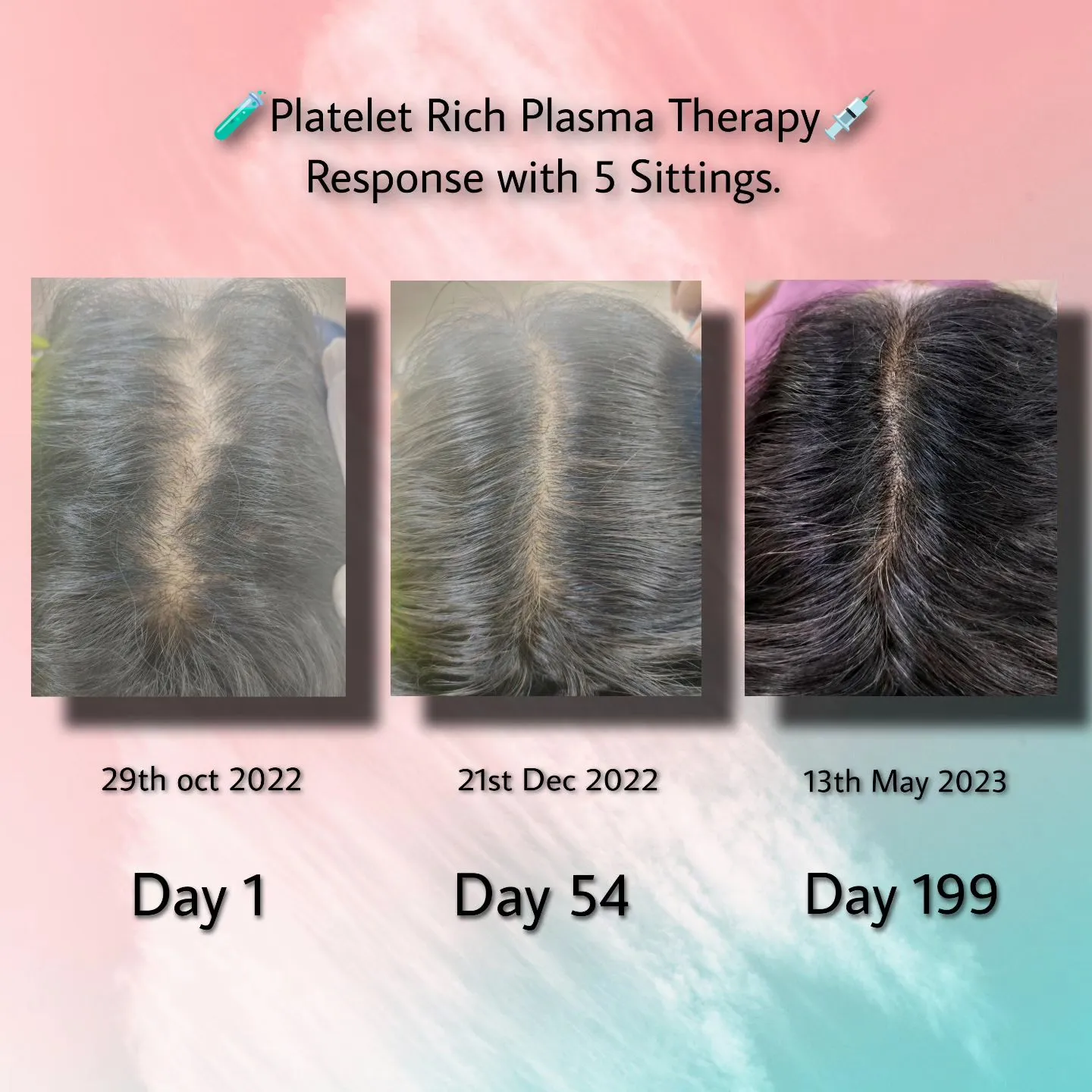 Platelet Rich plasma Theraphy; Response with 5 Sittings