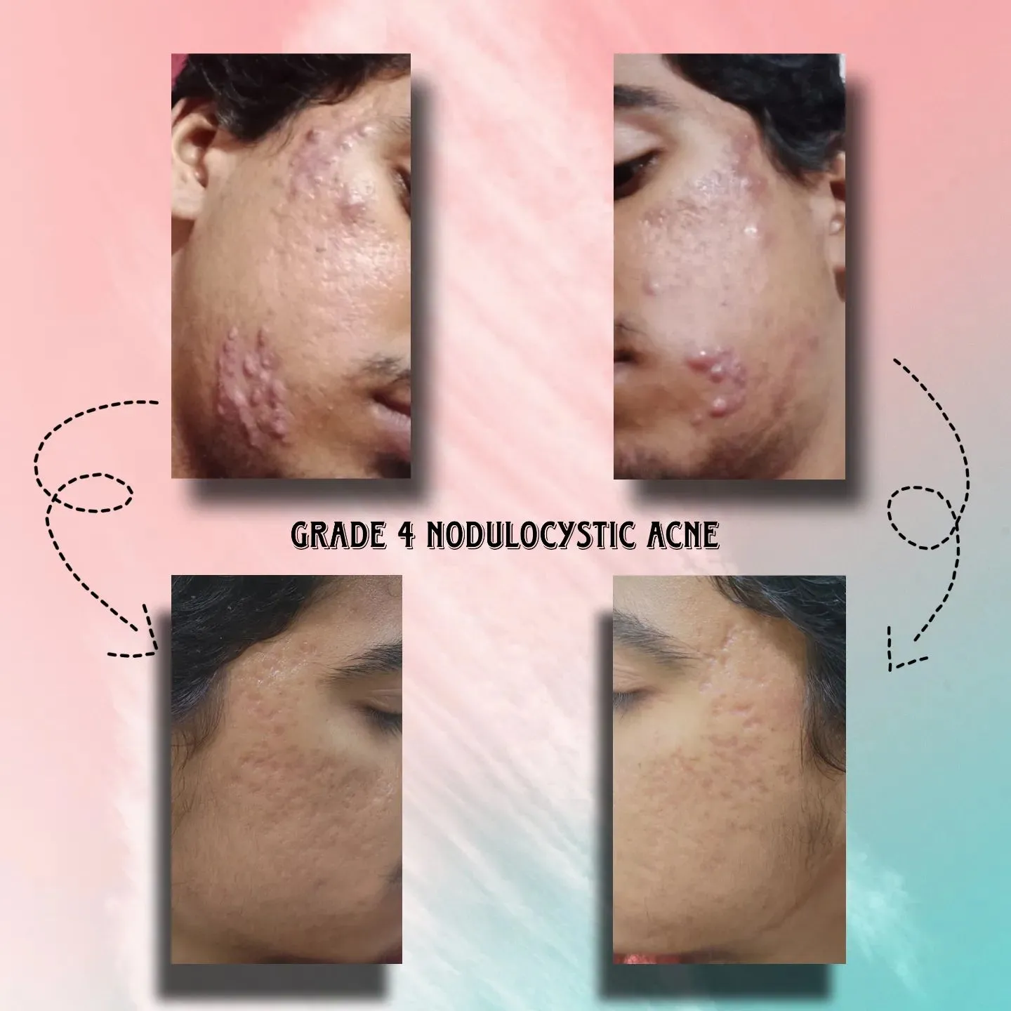 Grade 4  Modulocystic Acne