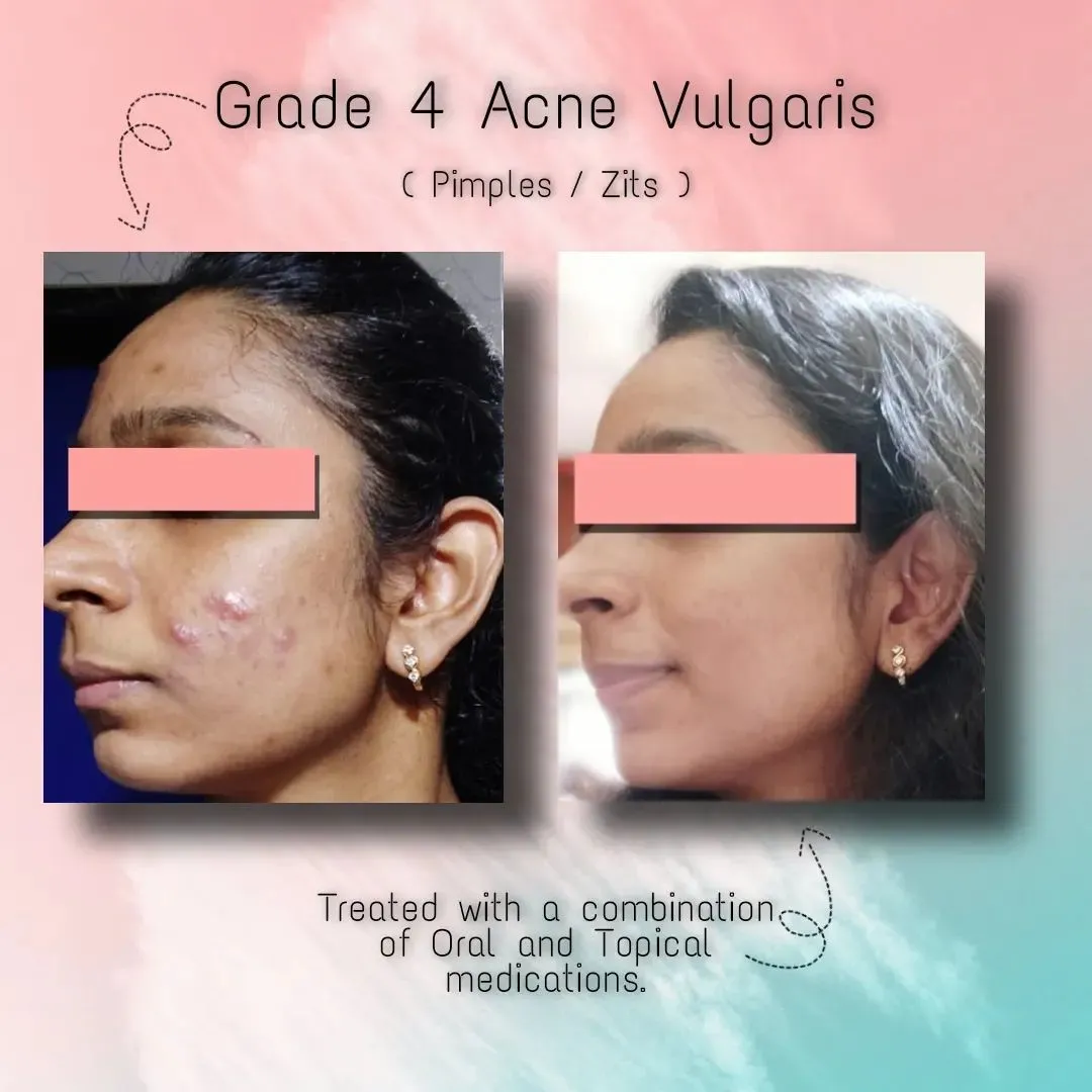 Grade 4 Acne Vulgaris - Pimples/Zits; Treated with a combination of Oral & Topical Medications