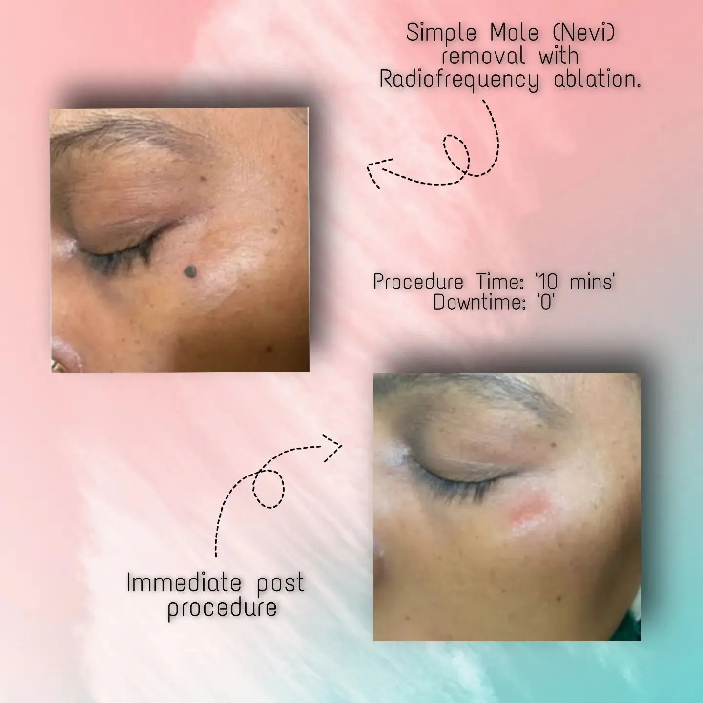 Simple Mole (Nevi) removal with Radiofrequency ablation