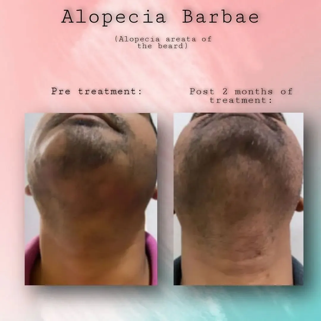 Alopecia Barbae Pre & Post Treatment