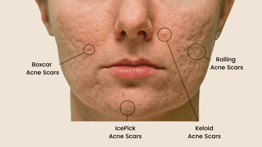 Understanding Acne Scars in Detail